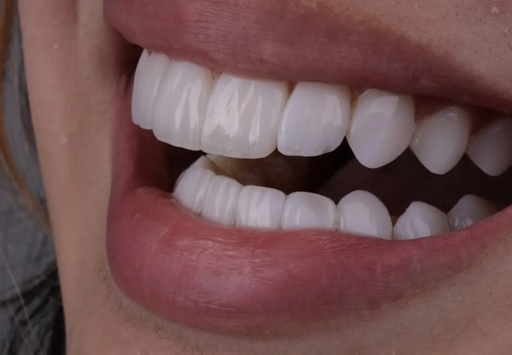 Resultado lateral das lentes em resina com aparência natural e encaixe harmônico no sorriso.